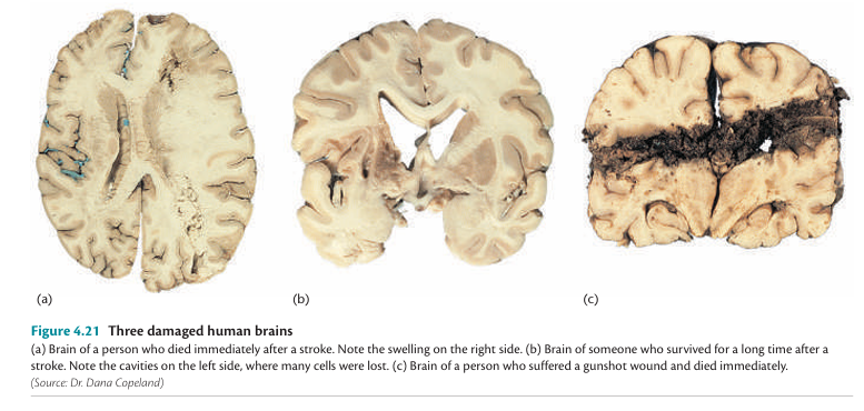 Types of Brain Injuries
